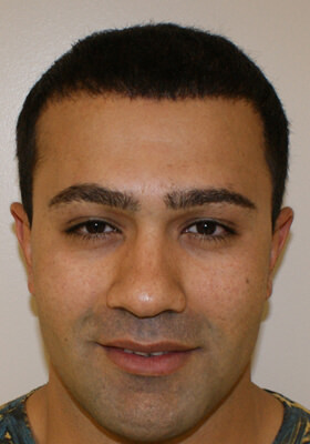 Rahim Burn Patients / Scar Repairs Hair Transplant 