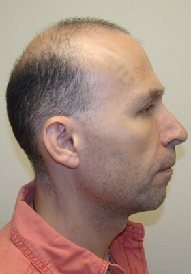 hair transplant photos