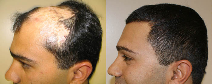 TRX2 Molecular Hair Growth Supplement | Stem Cell Baldness Cures
