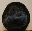 hair loss