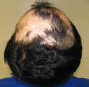 hair implants