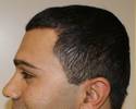 alopecia