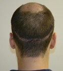 Hair Transplant Images 