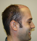 Hair Transplant Images 