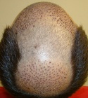 Hair Transplant Images 