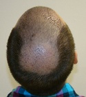 Hair Transplant Images 