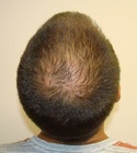 Hair Transplant Images 