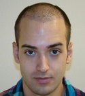 Hair Transplant Images 