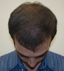 Hair Transplant Images 