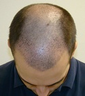 Hair Transplant Images 