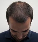 Hair Transplant Images 