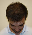 Hair Transplant Images 