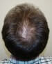 bald spot