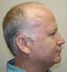 typical mail pattern baldness