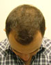 hair thinning
