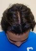 hair restoration before after pic
