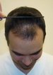 hair restoration before after pic