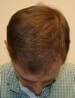 Hair Surgery