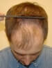 Hair Surgery