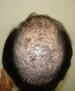 hair transplant correction