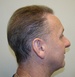 Hair Restoration