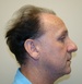 Hair Restoration