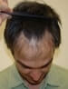 Hair Restoration