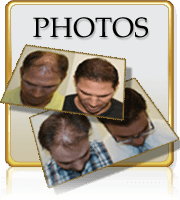 Hair Transplants Before After Photos