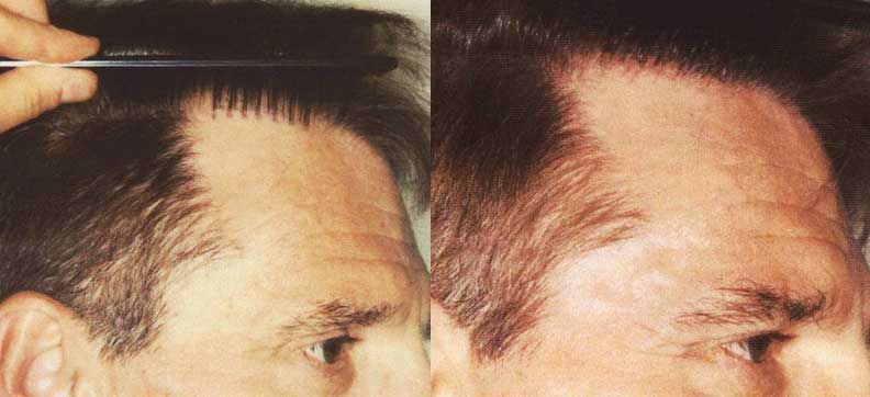 hair plugs