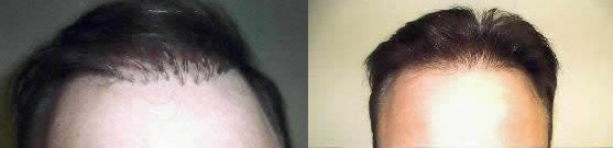hair plugs corrected