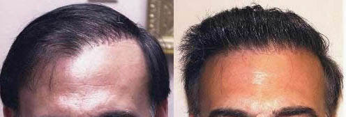 bad hair transplant
