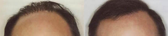 hair plugs