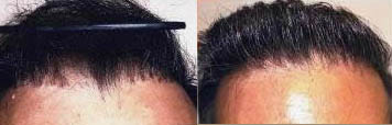 hair plugs
