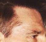 hair plugs corrected