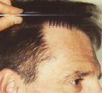 hair plugs