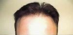 hair plugs corrected