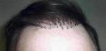 hair plugs