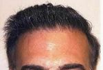 corrected hair transplant
