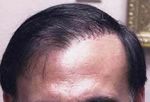 bad hair transplant
