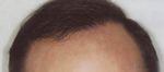 hair plugs corrected