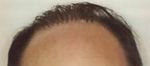 hair plugs