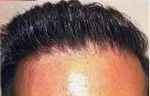 hair plugs corrected