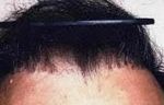 hair plugs