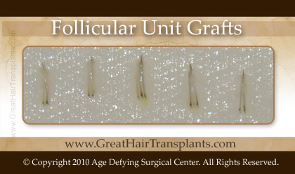 follicular unit grafts