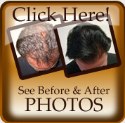 Hair Transplant Before After Photos