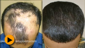balding