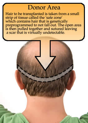 fort lauderdale hair transplant surgeon