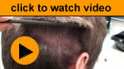 watch hair transplant scar videos