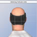 Hair Transplantation