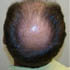 bald spot